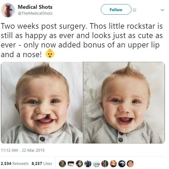 Medical shots themedicalshots follow two weeks post surgery. thos little rocksta