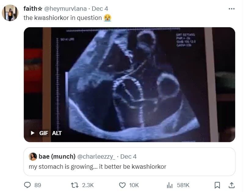 Faithx heymurvlana dec 4 the kwashiorkor in question gif alt bae munch charleezz